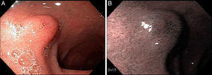 A) Lesión subepitelial en bulbo duodenal. B) Visión cromoendoscópica de lesión bulbar.