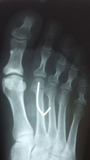 Imagen radiológica postoperatoria tras la realización de la osteotomía capital.