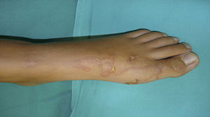 Lesiones serpiginosas en el dorso del pie izquierdo acompañadas de vesículas.