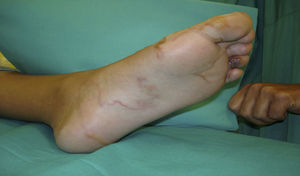 Cara plantar de pie izquierdo donde pueden verse las lesiones eritematosas que se presentaron inicialmente en el 4.° y 5.° dedos.