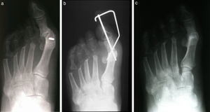 (a) This 80+ year old female had previously undergone removal of the lesser metatarsal heads and the proximal phalanges of the intermediate toes. A nonunion was also present at the 1st mpj. (b) Radiographic appearance following 1st mpj fusion. (c) 4.5 years postop.