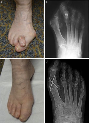 (a) Preoperative clinical and (b) radiographic appearance of an older patient with hallux abducto valgus deformity and an overlapping 2nd toe. (c) Clinical and (d) radiographic appearance 6 months following surgery with arthrodesis of the first metatarsophalangeal joint and hammertoe repair. A partial 2nd metatarsal head resection was performed as well.