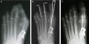 (a) A patient with recurrent hallux valgus deformity with a large intermetatarsal angle. (b) Immediate postoperative appearance and (c) 3 months postoperative. Notice the reduction in the intermetatarsal angle despite the fact that no osteotomy was performed as part of the revisional surgery.