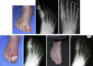 (a and b) Preoperative appearance of a patient with hallux varus and arthritic changes at the hallux interphalangeal joint. (c) Immediate postop films after 1st mpj fusion and hallux interphalangeal arthroplasty. (d and e) Clinical and radiographic appearance 6 months postoperatively with a nonunion of the 1st mpj. (f and g) Clinical and radiographic appearance of the foot 6 months after the removal of the wires with an asymptomatic nonunion.
