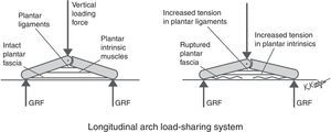 In this simplified model of the longitudinal of the foot, three of the four layers of the tension load-bearing elements of the LALSS are illustrated from superficial to deep: the plantar fascia, plantar intrinsic muscles and plantar ligaments. When vertical loading forces are applied to the dorsal aspect of the longitudinal arch and GRF increases plantar to the rearfoot and forefoot, the longitudinal arch starts to flatten which passively increases the tension within the plantar fascia and plantar ligaments. The CNS will also respond to arch flattening by increasing the contractile activity of the plantar intrinsics (left). With a rupture of the plantar fascia, the loss of plantar tension force from the plantar fascia will cause increased flattening of the longitudinal arch (right). The increased arch flattening will passively increase the tension within the plantar ligaments and will also cause the CNS to increase its efferent output to the plantar intrinsic muscles. The CNS may also respond by increasing the contractile activity of the extrinsic muscles of the plantar longitudinal arch (extrinsic muscles not illustrated in this model). In this manner, the unique load-sharing arrangement of the tension load-bearing elements of the LALSS will still allow proper longitudinal arch function even though one of its elements has ceased to function.