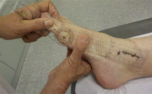 Method used for the measurement of 1st MTP joint dorsiflexion.