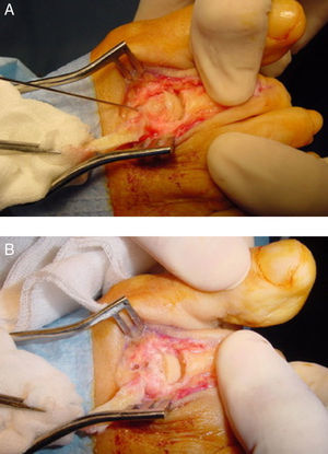 Fixation of the osteotomy. (A) Temporal Kirschner wire previous to insertion of the final fixation. (B) Final fixation of the osteotomy, in this particular case 2 absorbable Kirschner wires were used. The edge of the dorsal fragment has been removed.