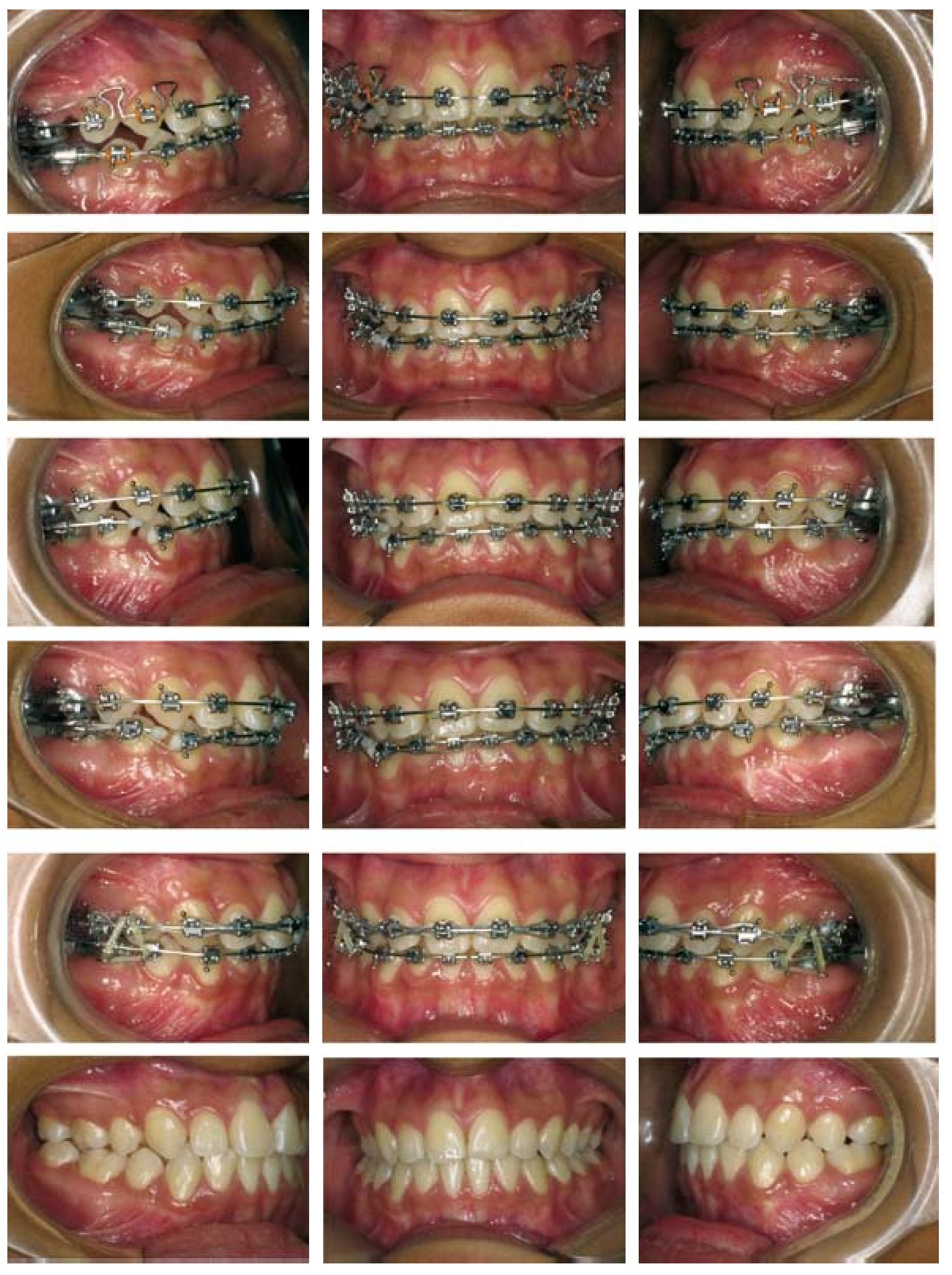 Los arcos dentales y su utilidad en ortodoncia con brackets