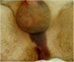 Cuando se detecta la perforación en el postoperatorio inmediato, se observa un cilindro más corto y un hematoma en la zona perineal.