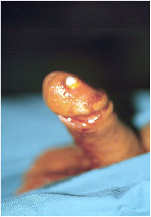 En los casos en los que hay fibrosis distal y además se ha debilitado el extremo distal de los cuerpos cavernosos, el cilindro quedaría muy superficial dentro del glande corriendo el riesgo de una erosión posterior.