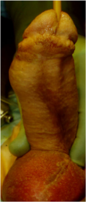 Normalmente, la colocación cruzada se detecta en el postoperatorio, momento en el que el paciente activa la prótesis. La deformidad percibida es obvia.