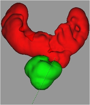 Caso1: Reconstrucción 3D de riñón en herradura con masa renal exofítica dependiente del istmo.