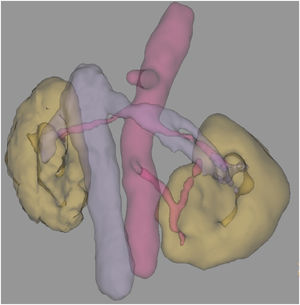 Caso 2: Reconstrucción 3D en la TC posquirúrgica que muestra resultado tras istmusectomía y nefrectomía parcial.
