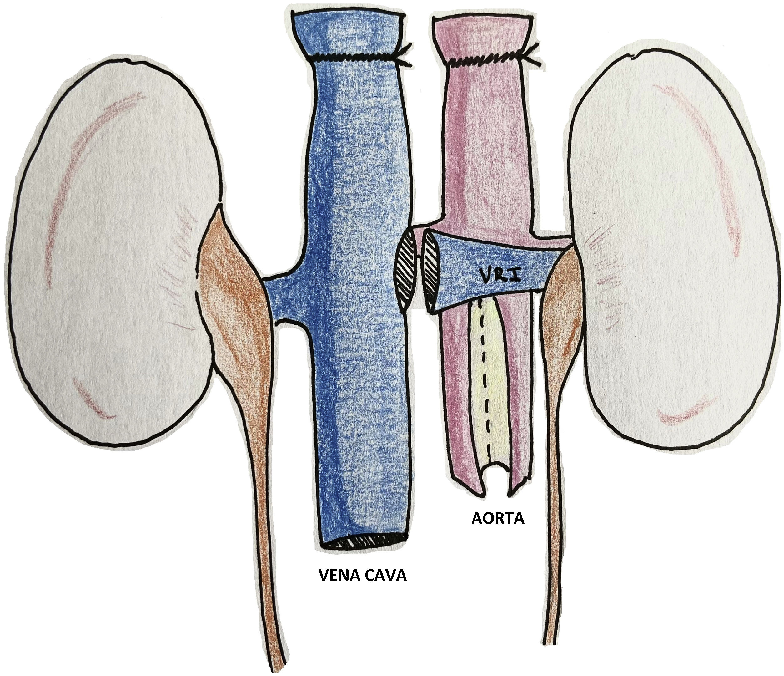 Riñon Extraido Extracción renal en donante cadáver: revisión sistemática de la técnica ...