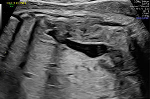 Hidronefrosis con hidrouréter. El riñón superior (derecho) muestra dilatación pélvica e hidrouréter. Imagen ecográfica del Centro Médico de la Universidad Erasmus.