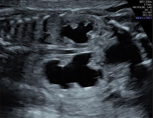 Obstrucción del tracto urinario inferior alrededor de las 23 semanas de edad gestacional. Obsérvese la hidronefrosis bilateral, más prominente en uno de los dos riñones. La vejiga también está agrandada (no visible en esta imagen). Imagen ecográfica del Centro Médico de la Universidad Erasmus.