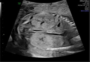 Enfermedad renal poliquística autosómica recesiva alrededor de las 20 semanas de edad gestacional. No se observa llenado vesical; nótese la presencia de anhidramnios. Imagen ecográfica del Centro Médico de la Universidad Erasmus.