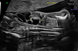 Displasia obstructiva alrededor de las 20 semanas de edad gestacional. Este feto masculino mostraba una obstrucción del tracto urinario inferior con riñones ecogénicos e hidrouréter severo; en esta imagen se visualiza y mide el riñón derecho. Imagen ecográfica del Centro Médico de la Universidad Erasmus.