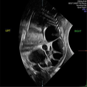 Riñón displásico multiquístico (RDMQ) alrededor de las 30 semanas de edad gestacional. Vista coronal de un RDMQ del lado derecho, que cruza la línea media. Imagen ecográfica del Centro Médico de la Universidad Erasmus.