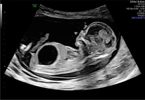 Megavejiga alrededor de las 13 semanas de edad gestacional. Obsérvese la cantidad normal de líquido amniótico. Imagen ecográfica del Centro Médico de la Universidad Erasmus.