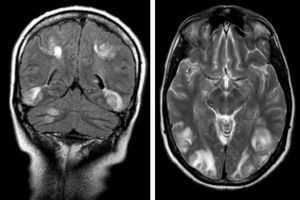 RMN cráneo con imágenes hiperintensas en secuencia flair coronal y T2, compatibles con Síndrome de PRES.