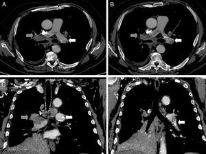Tomografía computada de tórax, donde se observa filtro de vena cava inferior (flecha continua) en arteria pulmonar izquierda, y trombo (flecha discontinua) en arteria pulmonar derecha, tanto en cortes axiales (A-B) como coronales (C-D).