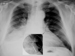 Radiografía de tórax, donde se evidencia filtro de vena cava inferior en campo pulmonar izquierdo, con dispositivo retráctil distal al corazón.