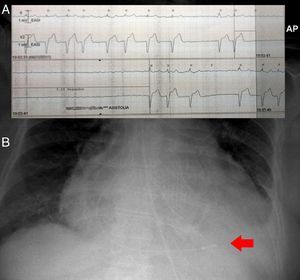 A) Episodio de asistolia de hasta 5 s. B) Radiografía de tórax que muestra electrodo (flecha) a nivel del ápex ventricular derecho.