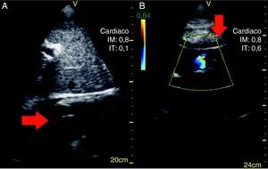 Imágenes de ecocardiografía obtenidas por ventana subcostal que muestran electrodo de estimulación (flechas) atravesando válvula tricúspide (A) y en ventrículo derecho (B).