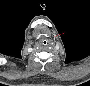 Trombosis de vena yugular externa derecha. En la imagen se aprecia la vena yugular externa izda. permeable (flecha) y la contralateral ausente (trombosada).