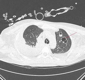 Nódulos pulmonares cavitados sugerentes de émbolos sépticos.