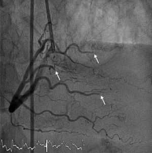Angiografía coronaria que muestra embolias múltiples con oclusión de ramas distales de arteria coronaria derecha (flechas).