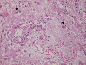 Biopsia pulmonar observando células con numerosas inclusiones intranucleares y citoplasmáticas: unas, eosinófilas con bordes angulosos y halo claro (flecha superior), y otras, binucleadas en vidrio esmerilado (flecha inferior), compatibles con inclusiones por el virus del herpes simple tipo 1 (VHS-1).