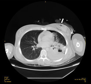 TC: orificio de entrada de la bala (flecha), hemoneumotórax y lesión del parénquima pulmonar.