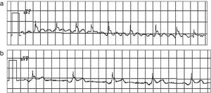 a) ECG preoperatorio: flutter auricular 3:1 con frecuencia ventricular superior a 100 lat./min. b) ECG postoperatorio: ritmo sinusal con signos de hipertrofia ventricular.