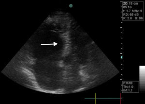 Proyección apical de 4 cámaras en 2D. Obsérvese el ventrículo izquierdo colapsado, las cavidades derechas dilatadas y el septo interventricular protruyendo hacia la izquierda durante la diástole.