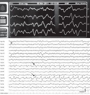 A) Imagen raw en el monitor BIS donde se observa la similitud de la morfología de los trazos derechos (RT, RE) y lo objetivado en el registro del EEG. B) EEG realizado de forma simultánea a la imagen mostrada en el panel A en el que se observan descargas epileptiformes focales rítmicas localizadas en la región frontal derecha (flechas). HF: 30Hz; LF: 0,53Hz; NF: 50Hz; trazo vertical: 100uV; trazo horizontal: 1 s.