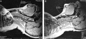 Magnetic resonance imaging scans of a single volunteer. Panel A shows the interscapular support with hyperextension position and Panel B shows the sniffing position. The closed polygons depict the area between the oro-pharyngeal airway and the line of site (A=43.60cm2, B=37.90cm2). The intersection between a horizontal line and a line drawn at the point where the two curves intersect, define the angle α (A=33.03°, B=5.97°).
