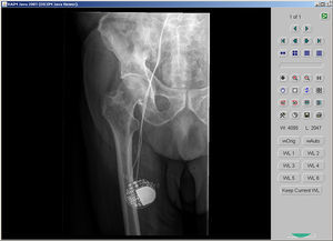 Radiografía con la ubicación del marcapasos femoral derecho, tras ser rechazado por anestesia para ser intervenido quirúrgicamente por alto riesgo quirúrgico, para colocación de marcapasos epicárdico.