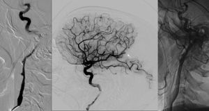 Disección de la arteria carótida derecha. La angiografía muestra CAD extracraneal en el segmento cervical (a, proyección extracraneal, y b, proyección intracraneal), y un embolismo distal a la arteria cerebral media (flecha). Posterior al procedimiento, se muestra recanalización de la CAD (c).