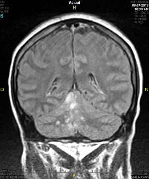 Lesiones parenquimatosas tipo nodular en secuencia T2 Flair en territorio de la cerebelosa superior derecha en RMN.