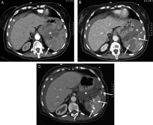 Fractura esplénica. Mujer de 77 años anticoagulada. Caída doméstica como consecuencia de un «mareo». En Urgencias, muestra hipotensión y distensión abdominal. A) TCCC con contraste, cortes axiales del abdomen superior en fase arterial. B y C) Fase venosa. Hemoperitoneo (*).Fuga de contraste e.v. al interior del parénquima esplénico y a la cavidad peritoneal (flecha) que aumenta de tamaño y densidad en la fase portal (b y c) por laceración esplénica con sangrado activo.