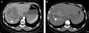 Mujer de 30 años. Golpe contra el manillar de la bicicleta. Consciente. Dolor a la palpación profunda. No irritación peritoneal. Tensión mantenida, hemograma normal. FAST negativo (no hemoperitoneo). A) Imagen axial de TC con contraste e.v., que muestra lesión focal hipocaptante (h) que afecta gran parte del lóbulo derecho, con focos de sangrado activo (cabeza de flecha). Se indica embolización percutánea. B) La TC sin contraste de control tras embolización (una semana) muestra lesión focal hepática hiperdensa (h), correspondiendo con el hematoma, con reducción de tamaño e imagen metálica debida al material de embolización (coil).
