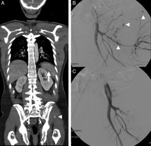 Varón de 54 años con traumatismo múltiple por accidente de automóvil. Constantes vitales mantenidas. A) TCCC en fase portal, reformateo MPR coronal, que muestra laceración esplénica con pequeño hematoma periesplénico y seudoaneurisma (flecha). Fractura compleja de pelvis izquierda con focos de sangrado activo (cabeza de flecha). B) La angiografía confirma múltiples focos de sangrado activo (cabezas de flecha). C) Focos de sangrado que se resuelven tras la embolización al igual que el seudoaneurisma esplénico (no mostrado).