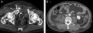 Varón de 40 años. Accidente de motocicleta. A) TCCC, plano axial de la pelvis mostrando fractura compleja del anillo pelviano, con fuga de contraste intravesical (sonda de Foley) a tejidos blandos (flecha). B) Plano axial del abdomen demostrando la ausencia de hemoperitoneo. Hematoma retroperitoneal ocupando el músculo psoas derecho (p) y la fascia retromesentérica (*).