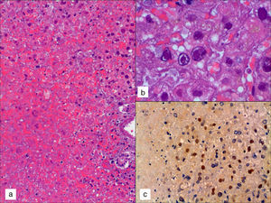 Hígado: a) imagen de la necrosis hemorrágica hepática masiva (hematoxilina-eosina [HE], 10×); b) detalle de los núcleos de hepatocitos con las inclusiones nucleares eosinófilas y el característico aspecto «en vidrio esmerilado» (HE, 40×); c) marcaje nuclear positivo frente al anticuerpo VHS-1 en hepatocitos (HE, 10×).