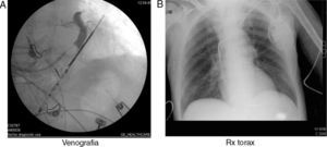 A)Venografía retrógrada oclusiva. B)Radiografía de tórax con electrodo en el ventrículo izquierdo.