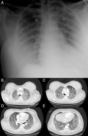 1A. Chest X-ray showing bilateral lung infiltrates. 1B-E. Chest CT angiographyshowing bilateral consolidations with air-bronchograms and ground-glass-appearing opacities suggestive of alveolar damage.