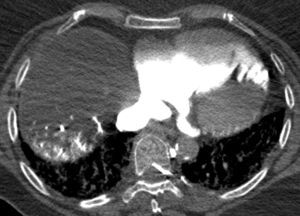 Contrast in the lower part of the right atrium and ventricle (arrowheads). Retrograde filling of the coronary sinus (*) and cardiac veins of the left ventricle (arrows).