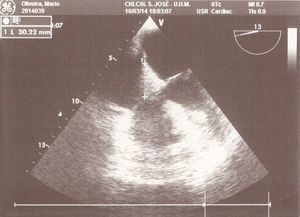 Image of the clot in the right atrium seen by transesophageal echocardiography.